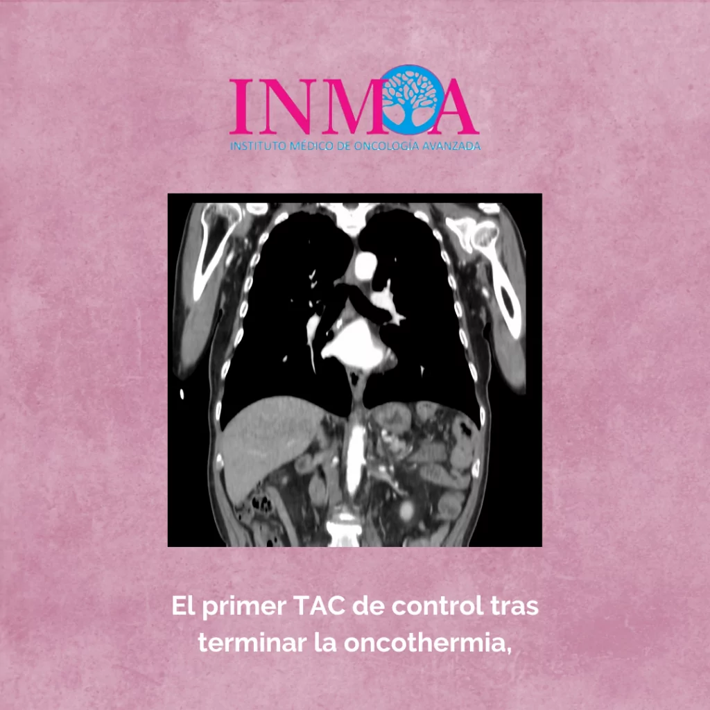 Caso de éxito de Oncothermia y testimonios reales de cáncer de estomago
