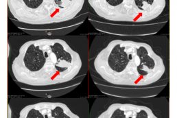 Cáncer de pulmón sin opciones terapéuticas tratado en monoterapia con hipertermia electromodulada.