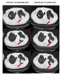 Cáncer de pulmón sin opciones terapéuticas tratado en monoterapia con hipertermia electromodulada.
