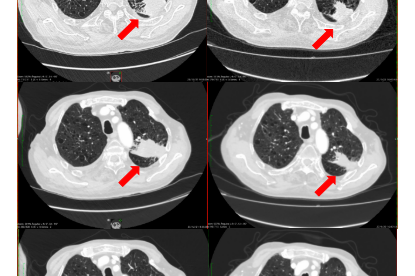 Cáncer de pulmón sin opciones terapéuticas tratado en monoterapia con hipertermia electromodulada.