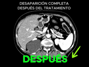 2025_02_23 Caso de éxito Oncothermia INMOA Cáncer de páncreas con metástasis_5 despues