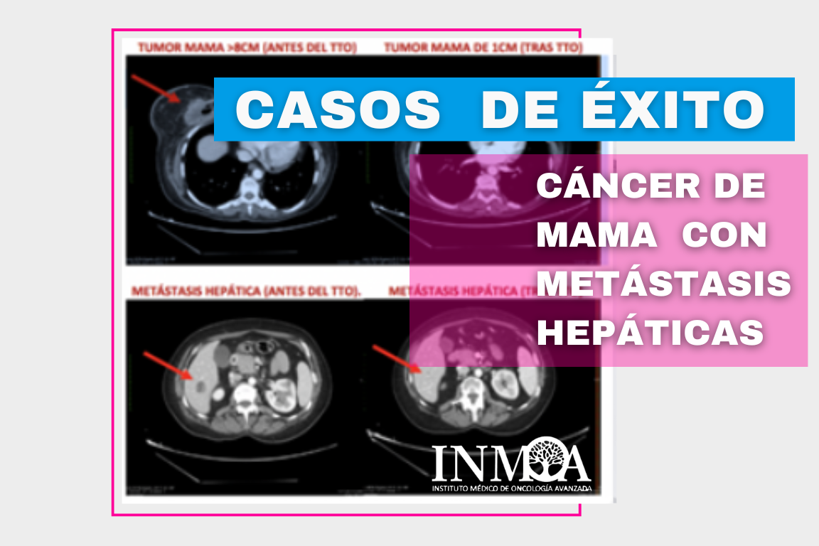 Caso de Éxito INMOA cancer de mama con metastasis hepaticas