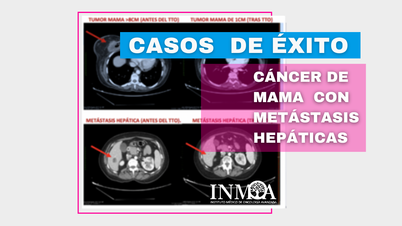 Caso de Éxito INMOA cancer de mama con metastasis hepaticas