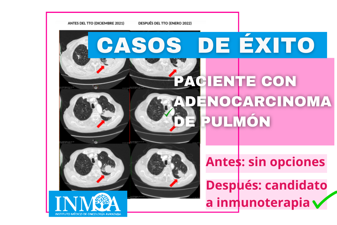 Caso de éxito en INMOA en cáncer de pulmón sin opciones_imagen destacada post
