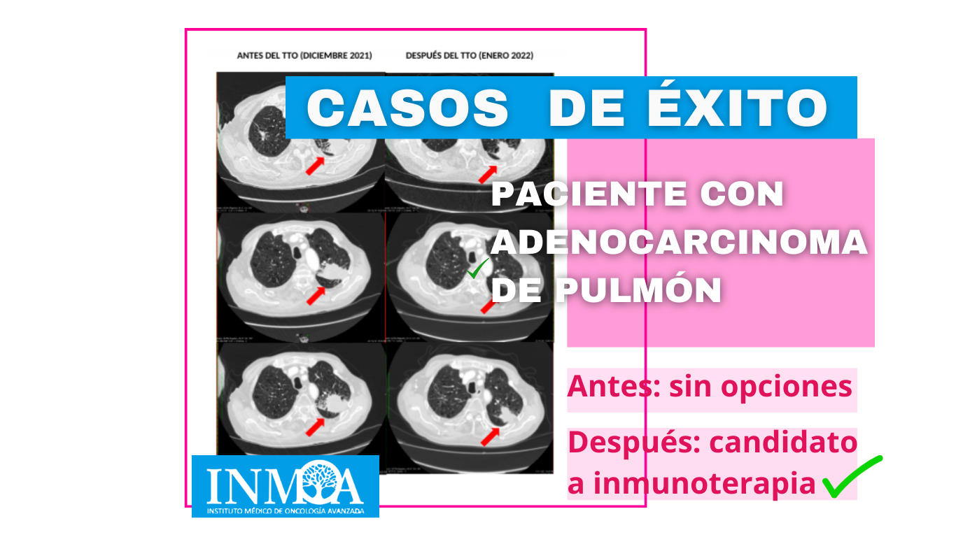 Caso de éxito en INMOA en cáncer de pulmón sin opciones_imagen destacada post