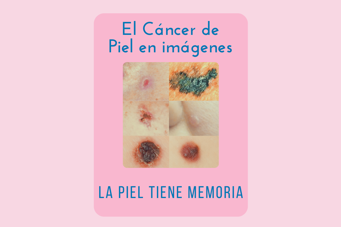 Cancer de piel fotos Ponencia Oncologa Dra. Arrojo INMOA_imagen destacada