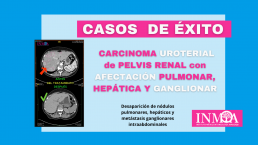 Caso de exito INMOA carcinoma uroterial_imagen destacada