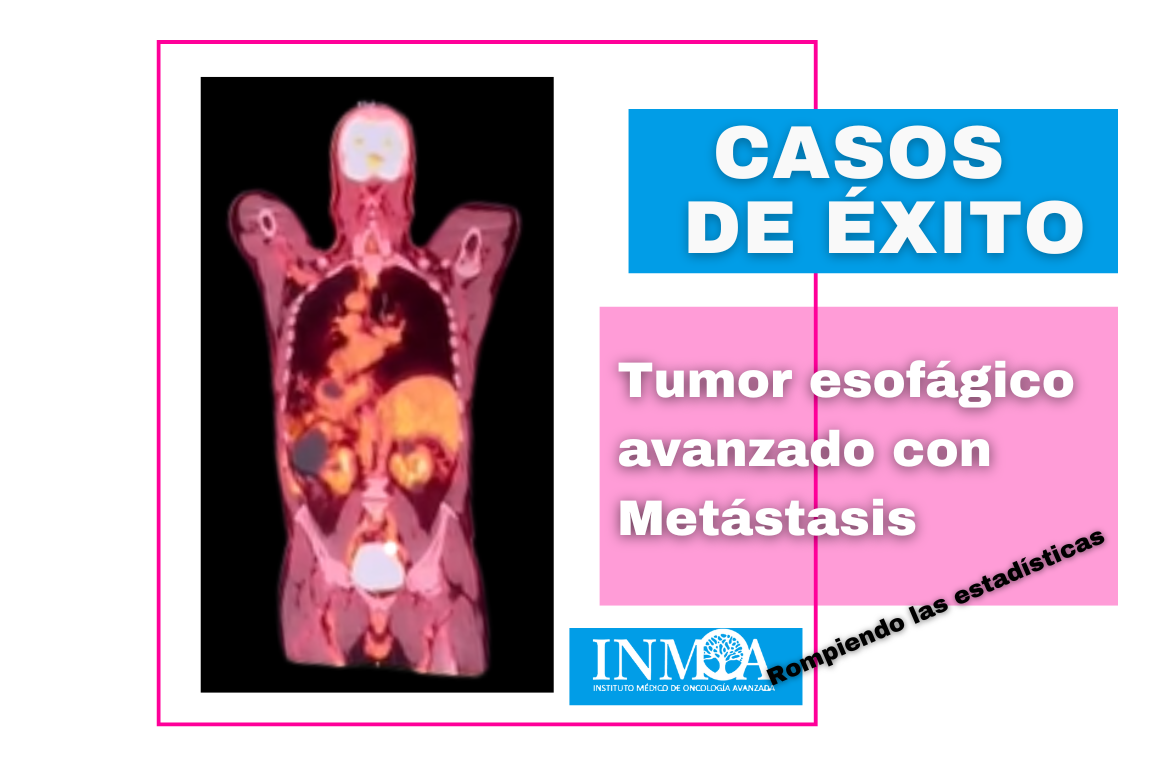 INMOA CASO DE ÉXITO REAL - Tumor esofágico avanzado con metástasis_imagen destacada
