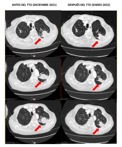 Cáncer de pulmón sin opciones terapéuticas tratado en monoterapia con hipertermia electromodulada.