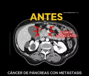 2025_02_23 Caso de éxito Oncothermia INMOA Cáncer de páncreas con metástasis_2 antes