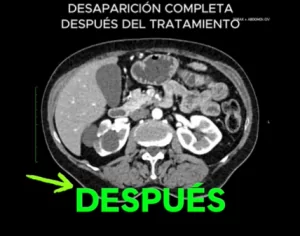 2025_02_23 Caso de éxito Oncothermia INMOA Cáncer de páncreas con metástasis_4 despues