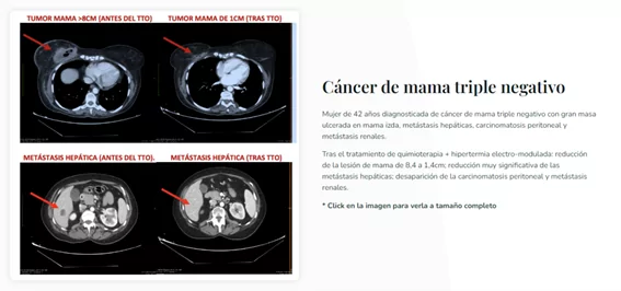 Caso de exito INMOA cancer de mama triple