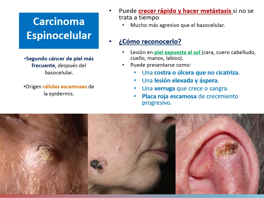 Cancer de piel fotos Ponencia Oncologa Dra. Arrojo INMOA_Carcinoma Espinocelular