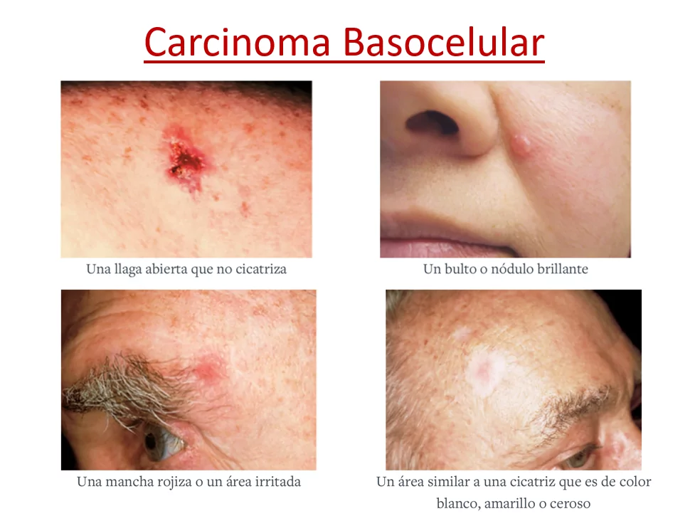 Cancer de piel fotos Ponencia Oncologa Dra. Arrojo INMOA_Carcinoma basocelular_1