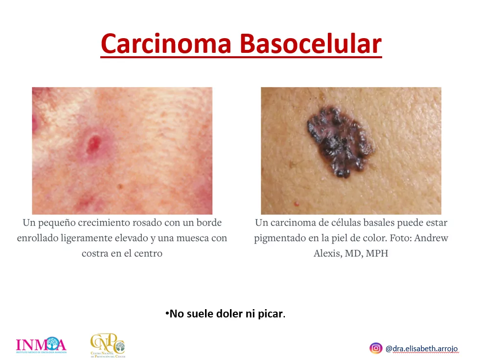 Cancer de piel fotos Ponencia Oncologa Dra. Arrojo INMOA_Carcinoma basocelular_2