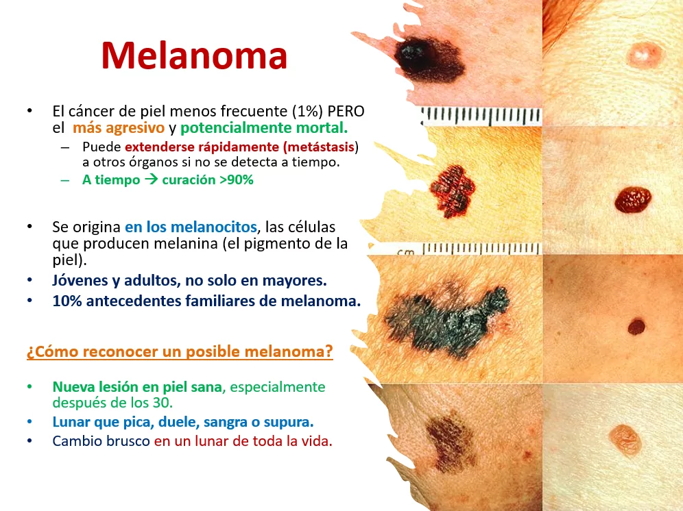 Cancer de piel fotos Ponencia Oncologa Dra. Arrojo INMOA_Melanoma