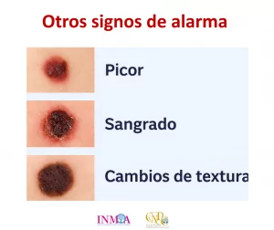 Cancer de piel fotos Ponencia Oncologa Dra. Arrojo INMOA_Otros signos de alarma para reconocer y prevenir
