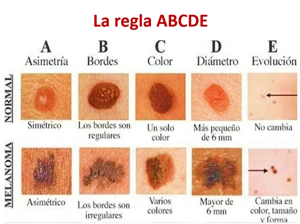 Cancer de piel fotos Ponencia Oncologa Dra. Arrojo INMOA_Regla ABCDE para reconocer y prevenir