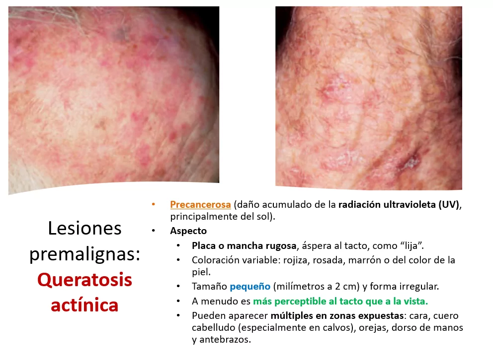 Cancer de piel fotos Ponencia Oncologa Dra. Arrojo INMOA_lesiones premalignas queratosis actínica
