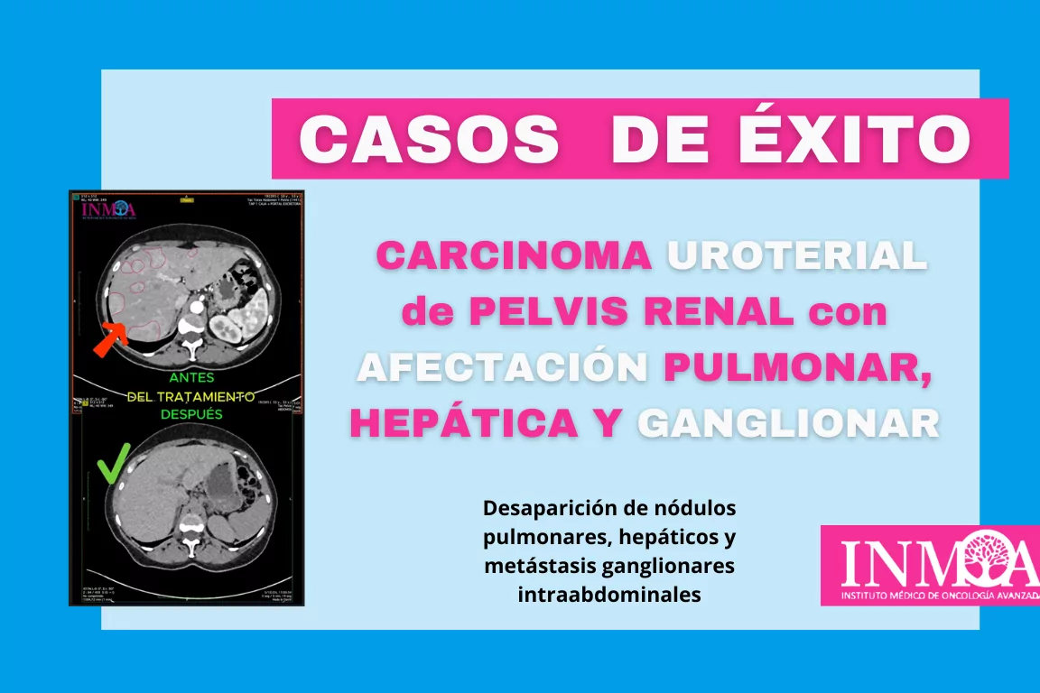 Caso de exito INMOA carcinoma uroterial_imagen destacada