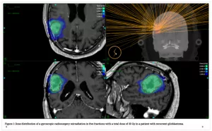 Imagen de la distribución de la Radiocirugía Gyroscópica en Investigación Oncológica en INMOA sobre Gliomas Oncotermia