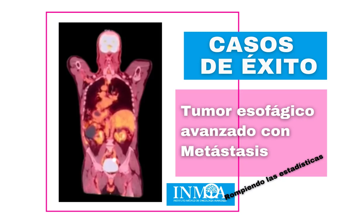 INMOA CASO DE ÉXITO REAL - Tumor esofágico avanzado con metástasis_imagen destacada