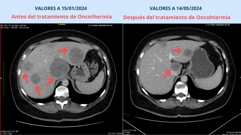 Testimonios reales de cáncer y casos de éxito de INMOA en mayo 2024